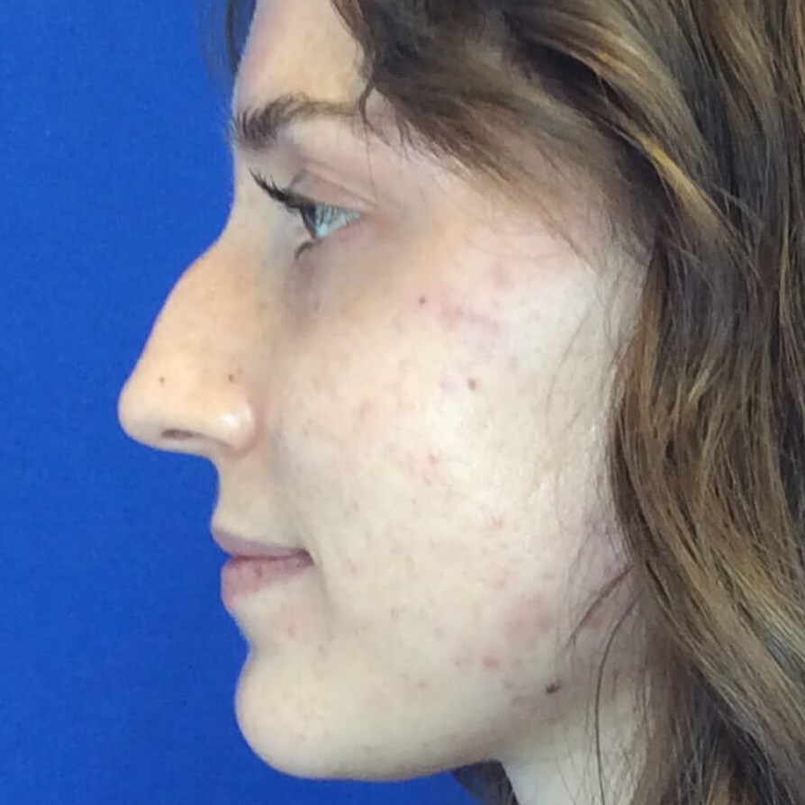 Dr Suzman Rhinoplasty Surgeon
